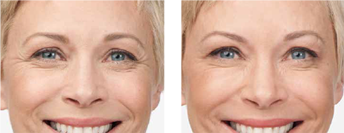 Botox Woman Before & After