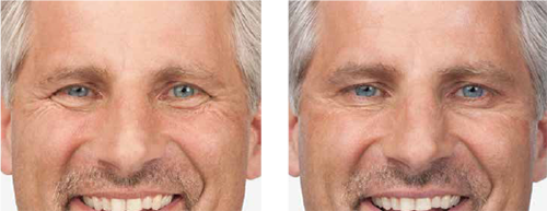 Botox Man Before & After