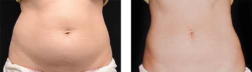 Coolsculpting Belly Before & After